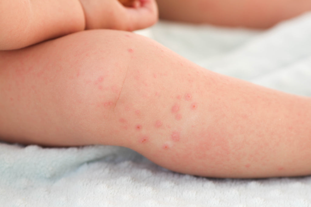 How to Prevent Diaper Rashes in Babies: Causes, Symptoms & Treatment