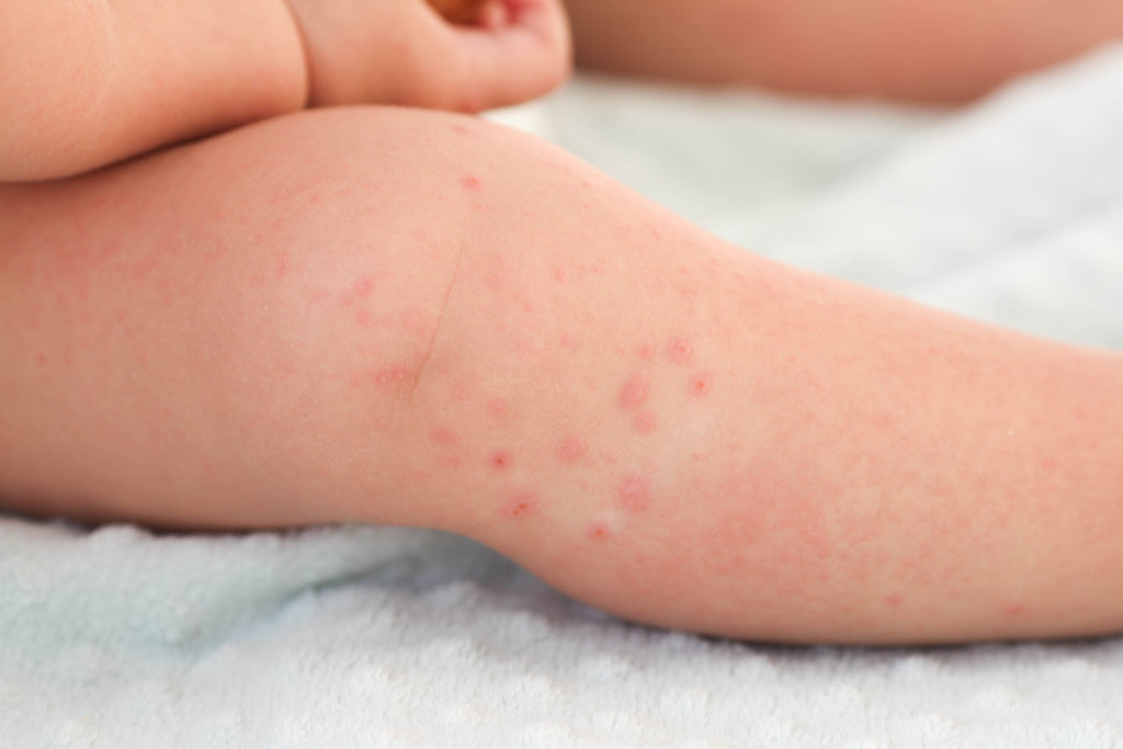 How to Prevent Diaper Rashes in Babies: Causes, Symptoms & Treatment ...