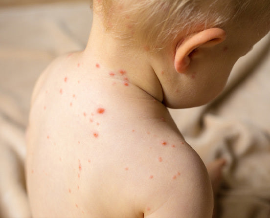 Chickenpox in Children: Causes, Symptoms, Treatment & Prevention